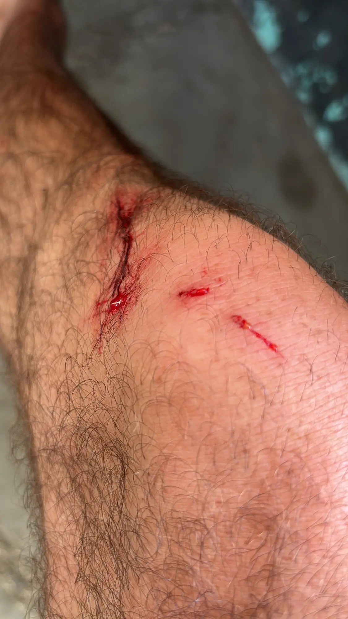 Close-up of a scraped knee with shallow reef cuts from surfing at Lakey Peak